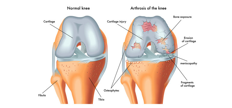 How a Spring Saves Knees - The Yorkshire Knee Clinic